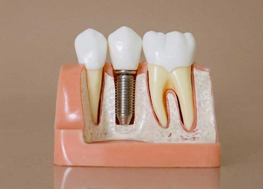 Dental Implant