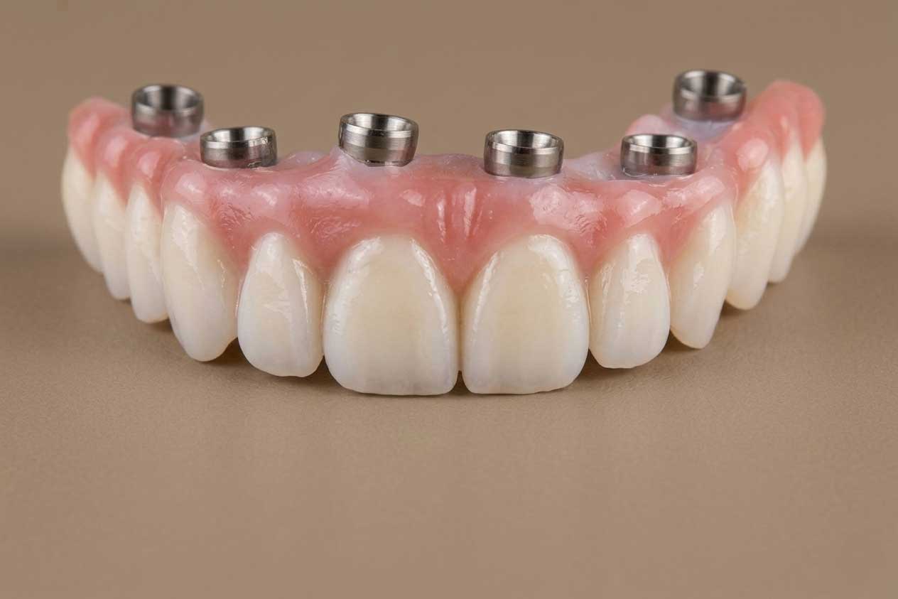 Full Mouth Reconstruction