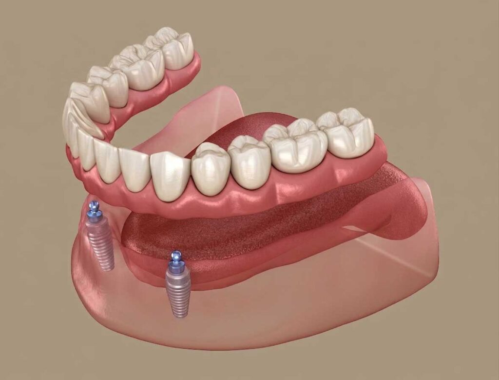 Implant Overdenture