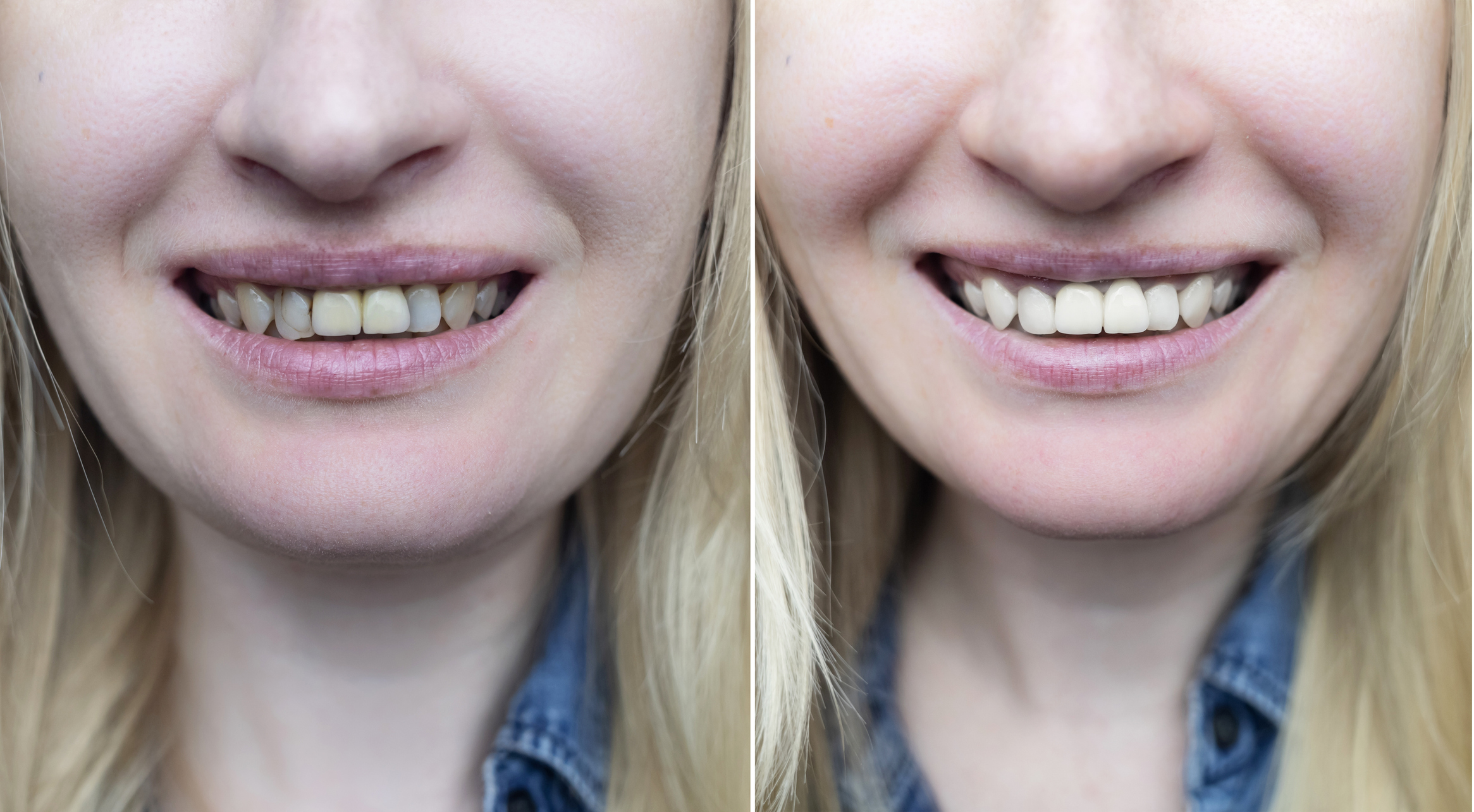 Successful restoration of front incisors. High-quality before and after photos of artistic dental restoration. Tooth build-up and reconstruction for a healthy smile.